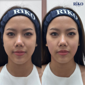 เบญ 600shot(แก้ม400เหนียง200)