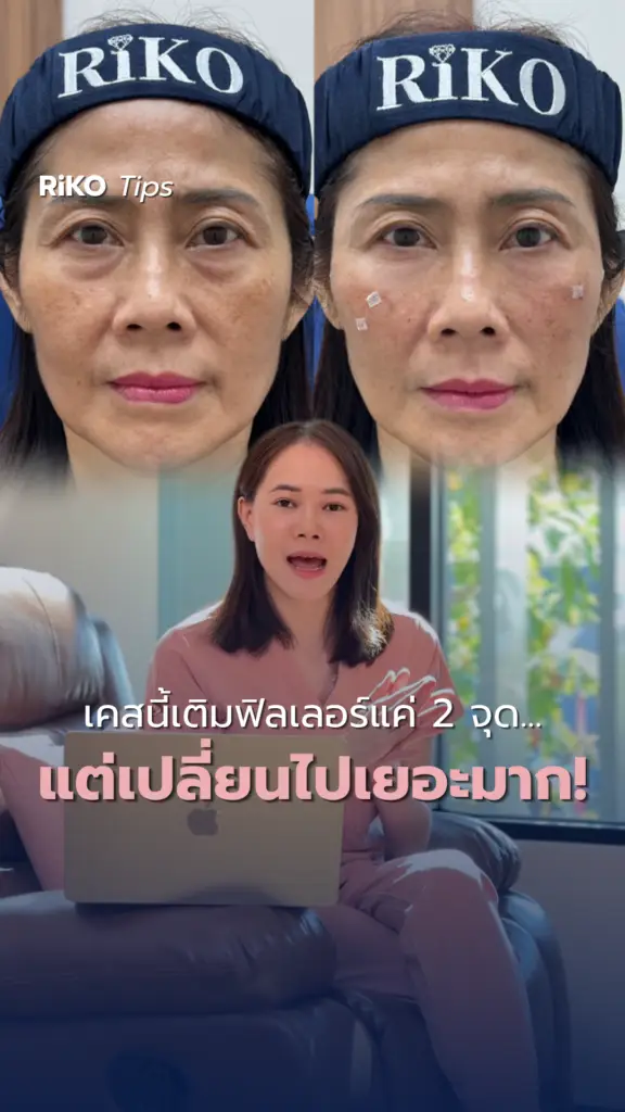 ภาพปกบทความ เคสกู้หน้าโทรมด้วยฟิลเลอร์! กับหมอเจีย | Riko Clinic ริโกะคลินิกเวชกรรม