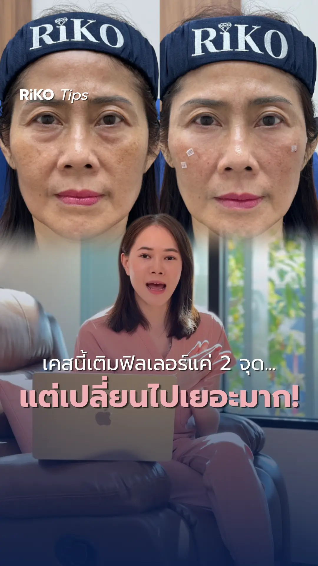 ภาพปกบทความ เคสกู้หน้าโทรมด้วยฟิลเลอร์! กับหมอเจีย | Riko Clinic ริโกะคลินิกเวชกรรม