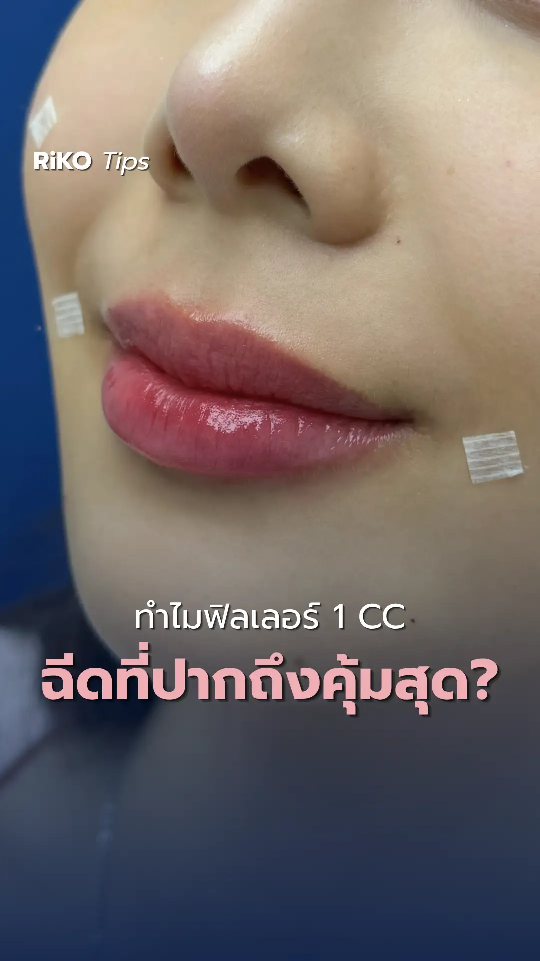 ภาพปกบทความ Riko Radiant Plus กู้ผิวโทรม คืนความกระจ่างใสแบบเร่งด่วน | Riko Clinic ริโกะคลินิกเวชกรรม ภาพที่ 1