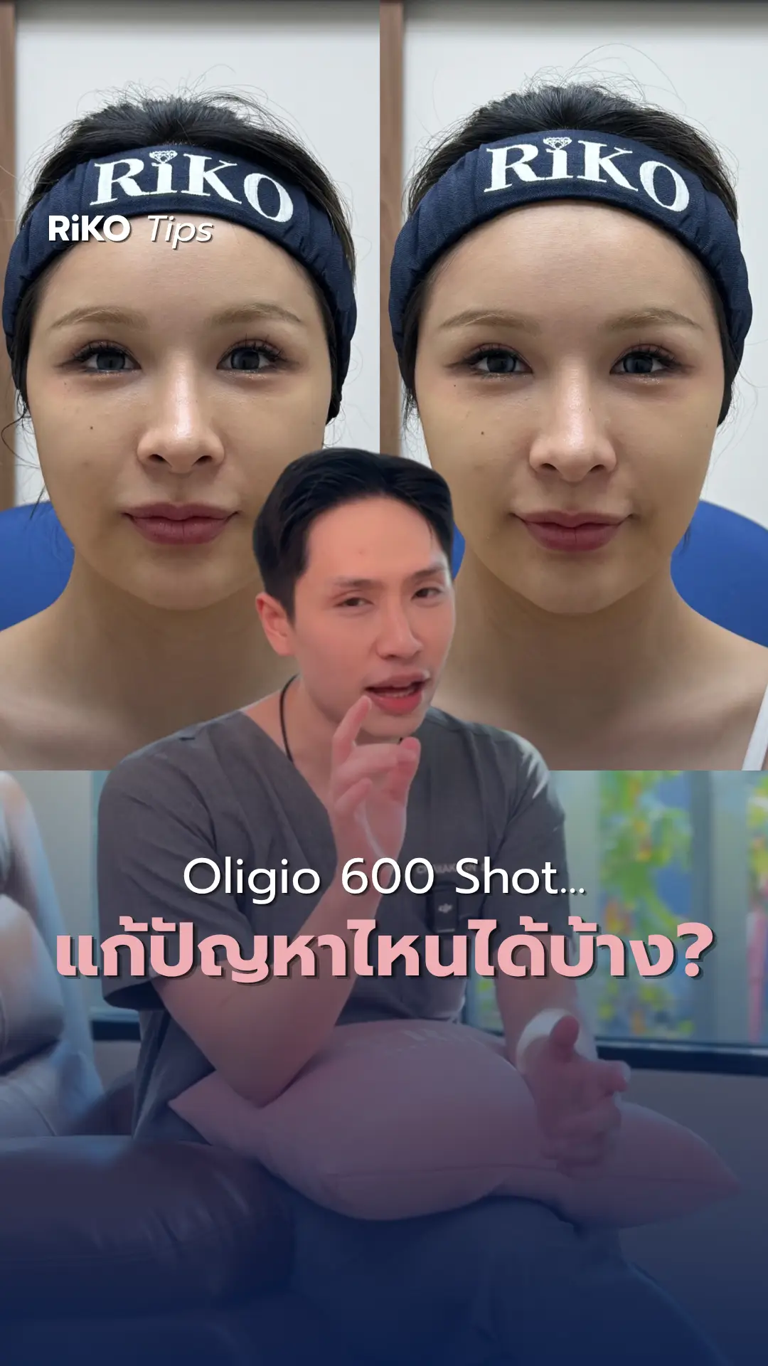 ภาพปกบทความ Oligio 600 Shot ยกกระชับ เก็บเหนียง | Riko Clinic ริโกะคลินิกเวชกรรม