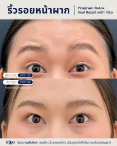 รีวิวลูกค้าโบท็อกซ์ | Riko Clinic ริโกะคลินิกเวชกรรม ภาพที่ 7
