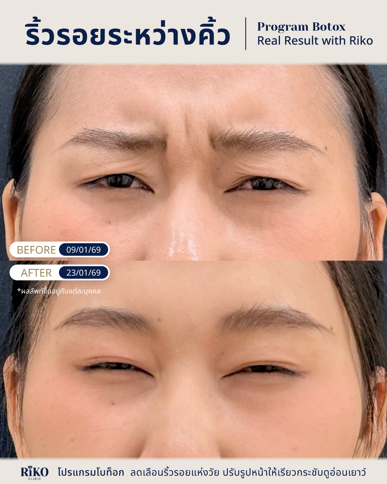 รีวิวลูกค้าโบท็อกซ์ | Riko Clinic ริโกะคลินิกเวชกรรม ภาพที่ 6