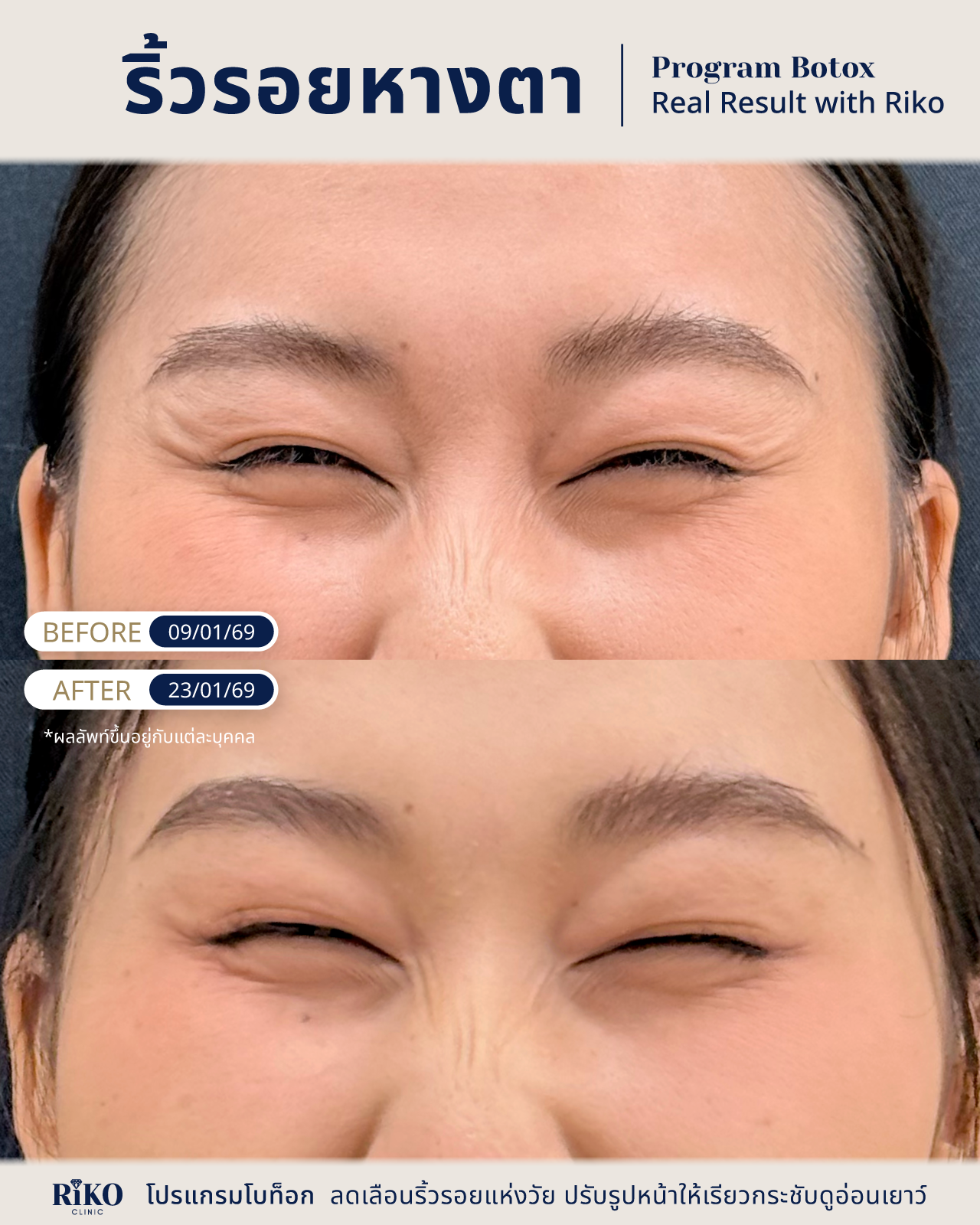 รีวิวลูกค้าโบท็อกซ์ | Riko Clinic ริโกะคลินิกเวชกรรม ภาพที่ 5