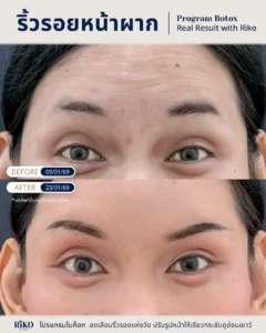 รีวิวลูกค้าโบท็อกซ์ | Riko Clinic ริโกะคลินิกเวชกรรม ภาพที่ 4