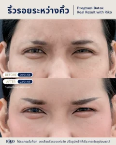 รีวิวลูกค้าโบท็อกซ์ | Riko Clinic ริโกะคลินิกเวชกรรม ภาพที่ 3