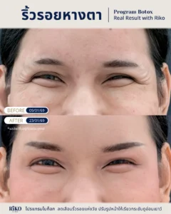 รีวิวลูกค้าโบท็อกซ์ | Riko Clinic ริโกะคลินิกเวชกรรม ภาพที่ 2
