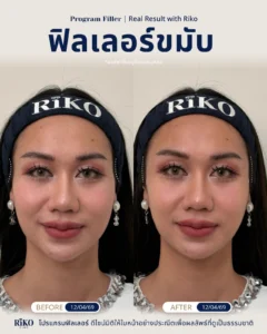 รีวิวลูกค้าฟิลเลอร์ขมับ | Riko Clinic ริโกะคลินิกเวชกรรม ภาพที่ 8