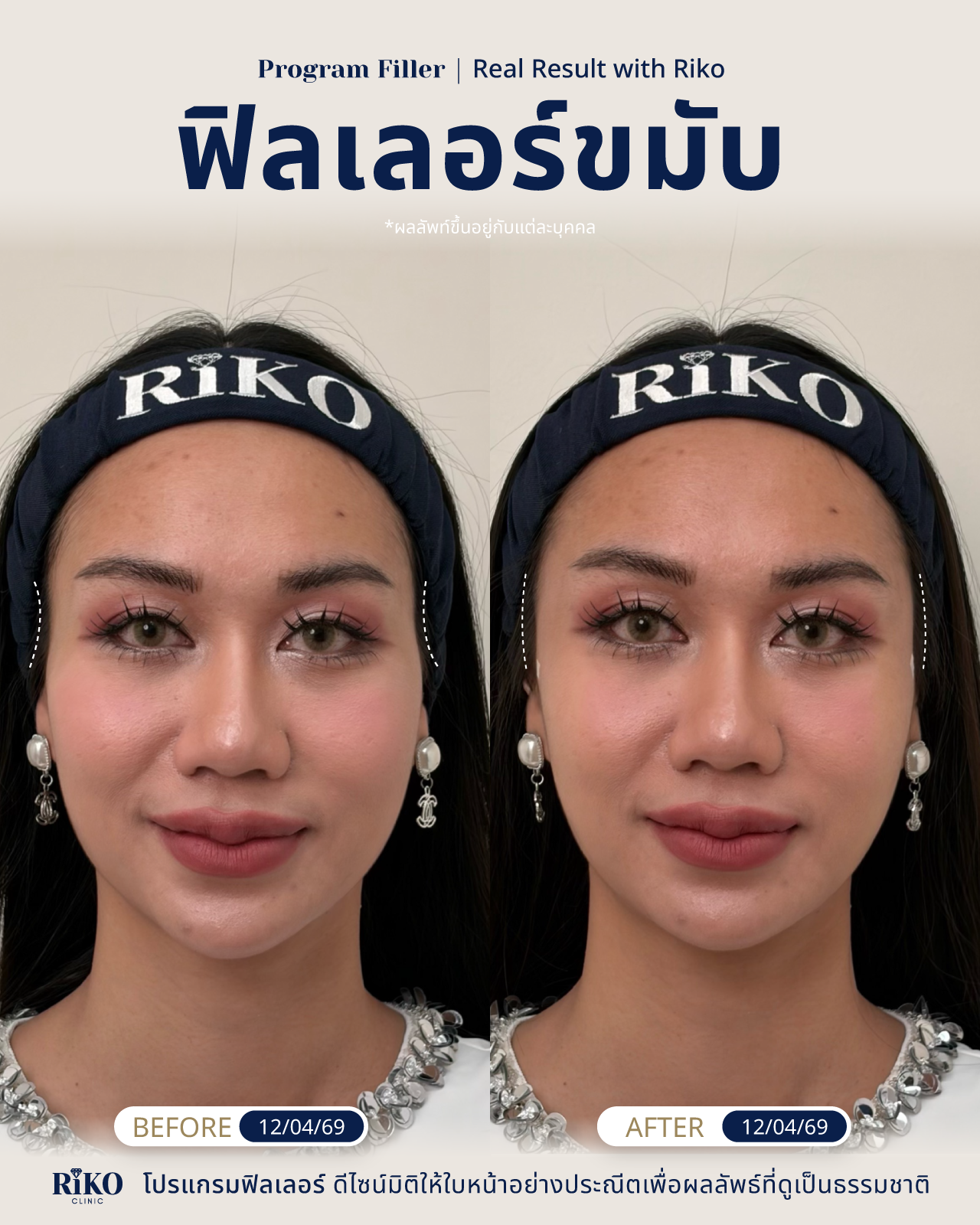 รีวิวลูกค้าฟิลเลอร์ขมับ | Riko Clinic ริโกะคลินิกเวชกรรม ภาพที่ 8
