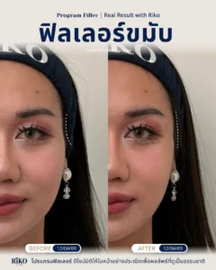 รีวิวลูกค้าฟิลเลอร์ขมับ | Riko Clinic ริโกะคลินิกเวชกรรม ภาพที่ 7