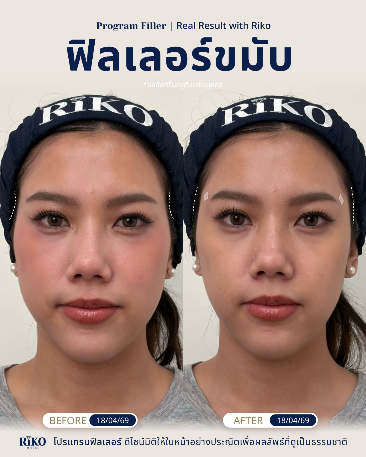 รีวิวลูกค้าฟิลเลอร์ขมับ | Riko Clinic ริโกะคลินิกเวชกรรม ภาพที่ 6