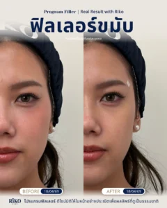 รีวิวลูกค้าฟิลเลอร์ขมับ | Riko Clinic ริโกะคลินิกเวชกรรม ภาพที่ 5