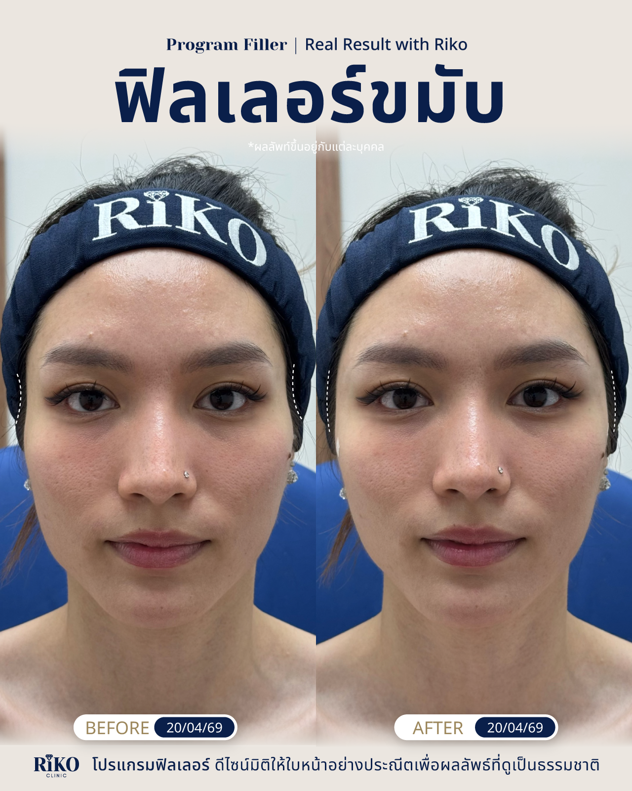 รีวิวลูกค้าฟิลเลอร์ขมับ | Riko Clinic ริโกะคลินิกเวชกรรม ภาพที่ 4
