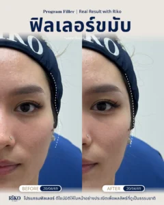 รีวิวลูกค้าฟิลเลอร์ขมับ | Riko Clinic ริโกะคลินิกเวชกรรม ภาพที่ 3