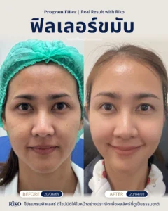 รีวิวลูกค้าฟิลเลอร์ขมับ | Riko Clinic ริโกะคลินิกเวชกรรม ภาพที่ 2