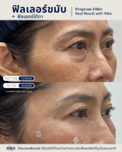 รีวิวลูกค้าฟิลเลอร์ขมับ | Riko Clinic ริโกะคลินิกเวชกรรม ภาพที่ 1