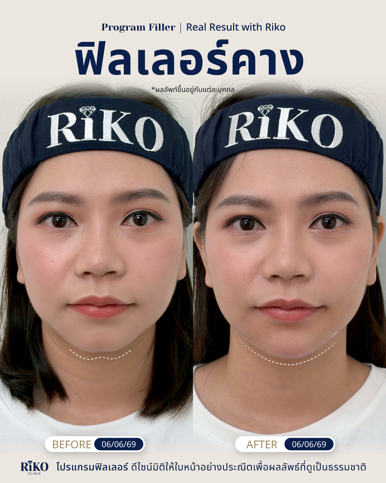 รีวิวลูกค้าฟิลเลอร์คาง | Riko Clinic ริโกะคลินิกเวชกรรม ภาพที่ 7