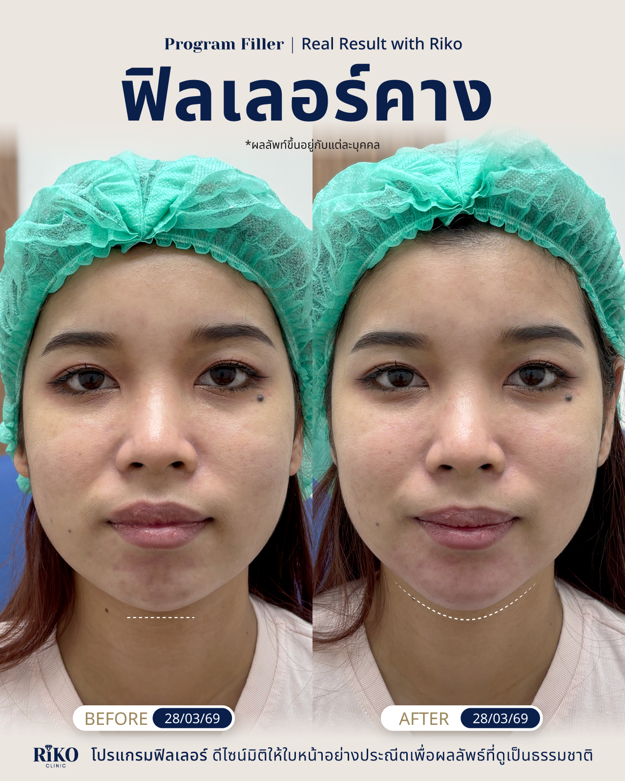 รีวิวลูกค้าฟิลเลอร์คาง | Riko Clinic ริโกะคลินิกเวชกรรม ภาพที่ 5