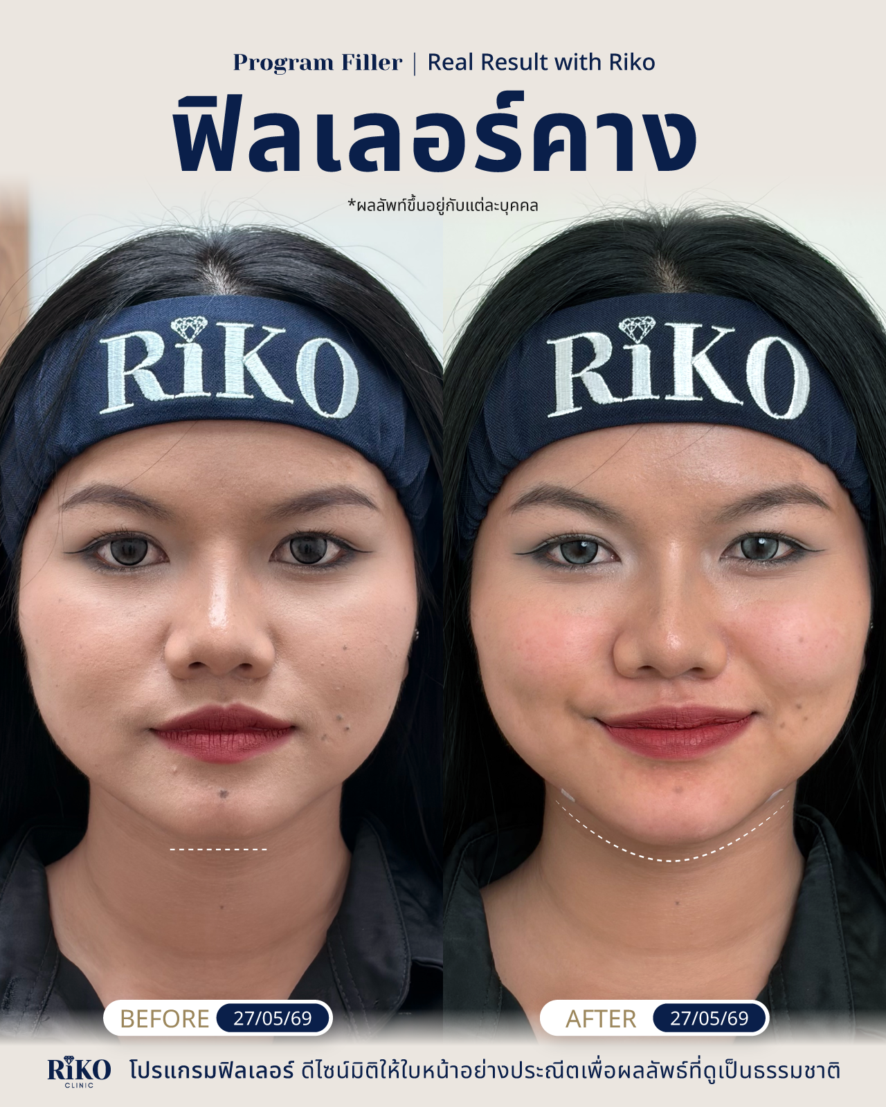 รีวิวลูกค้าฟิลเลอร์คาง | Riko Clinic ริโกะคลินิกเวชกรรม ภาพที่ 3
