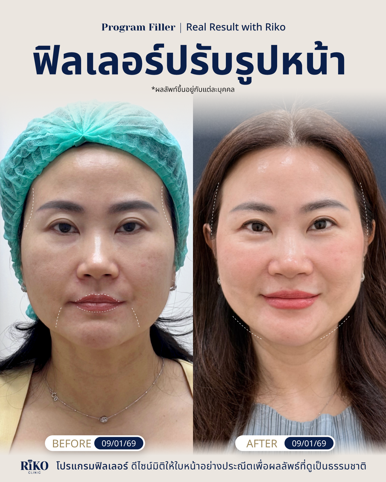 รีวิวลูกค้าฟิลเลอร์ปรับรูปหน้า | Riko Clinic ริโกะคลินิกเวชกรรม ภาพที่ 4