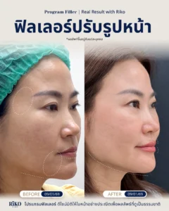 รีวิวลูกค้าฟิลเลอร์ปรับรูปหน้า | Riko Clinic ริโกะคลินิกเวชกรรม ภาพที่ 3
