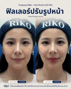 รีวิวลูกค้าฟิลเลอร์ปรับรูปหน้า | Riko Clinic ริโกะคลินิกเวชกรรม ภาพที่ 2