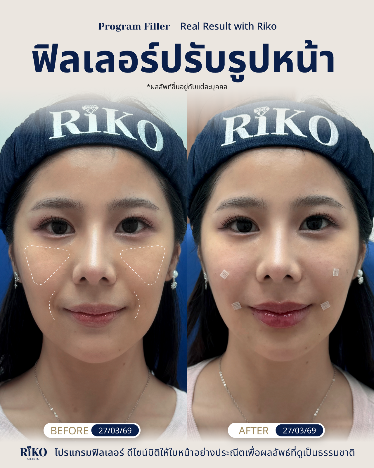 รีวิวลูกค้าฟิลเลอร์ปรับรูปหน้า | Riko Clinic ริโกะคลินิกเวชกรรม ภาพที่ 2