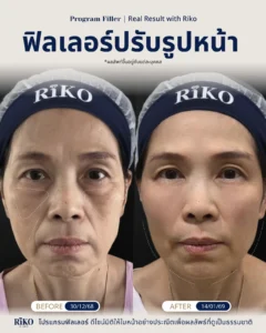 รีวิวลูกค้าฟิลเลอร์ปรับรูปหน้า | Riko Clinic ริโกะคลินิกเวชกรรม ภาพที่ 1