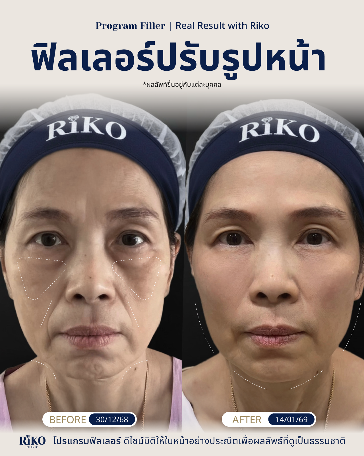 รีวิวลูกค้าฟิลเลอร์ปรับรูปหน้า | Riko Clinic ริโกะคลินิกเวชกรรม ภาพที่ 1
