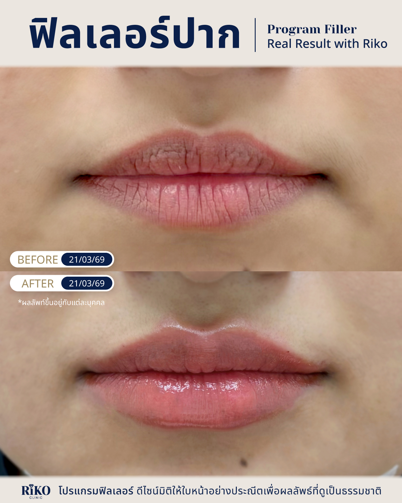 รีวิวลูกค้าฟิลเลอร์ปาก | Riko Clinic ริโกะคลินิกเวชกรรม ภาพที่ 3
