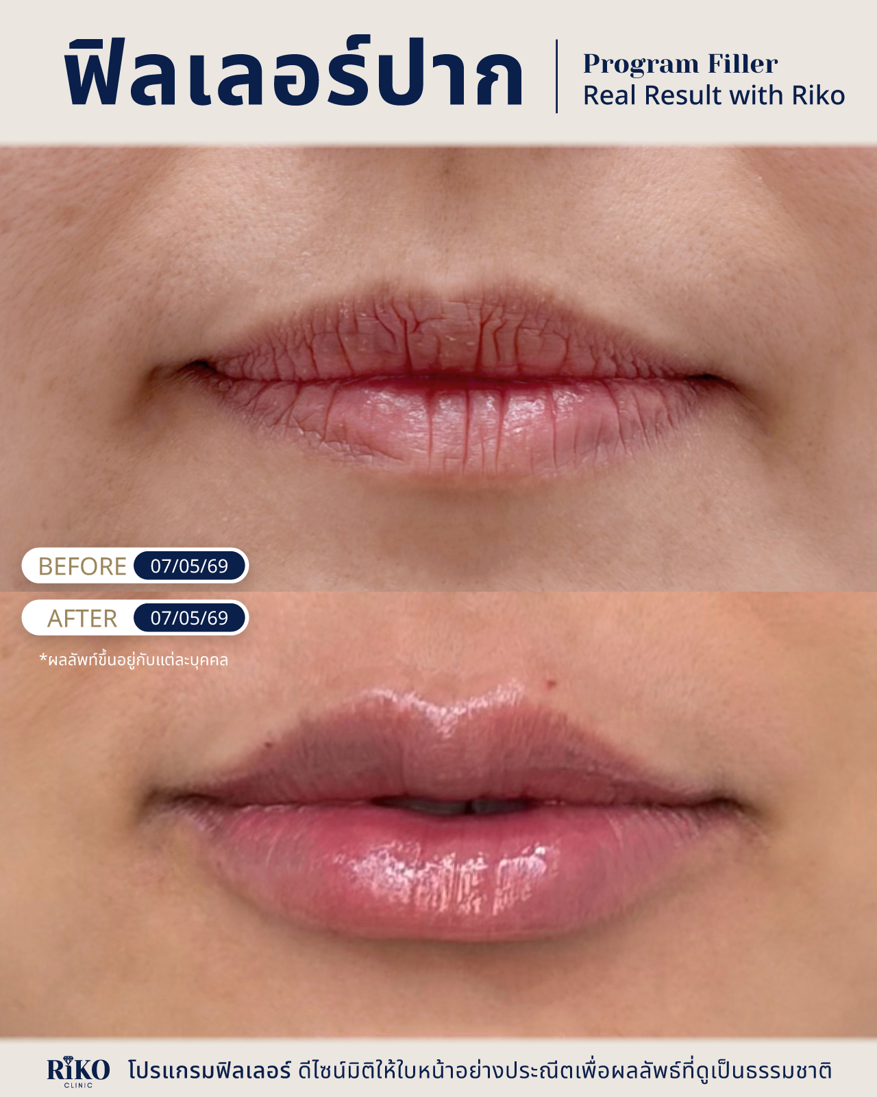 รีวิวลูกค้าฟิลเลอร์ปาก | Riko Clinic ริโกะคลินิกเวชกรรม ภาพที่ 2