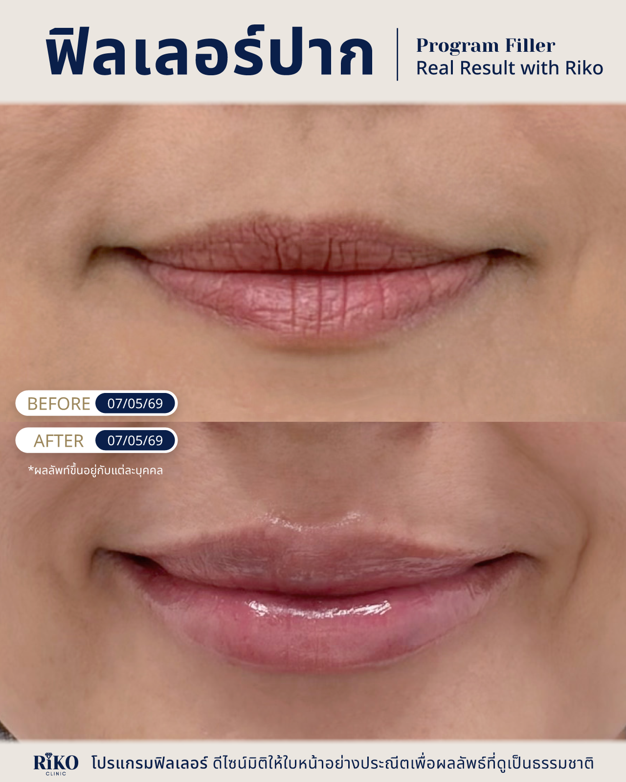 รีวิวลูกค้าฟิลเลอร์ปาก | Riko Clinic ริโกะคลินิกเวชกรรม ภาพที่ 1