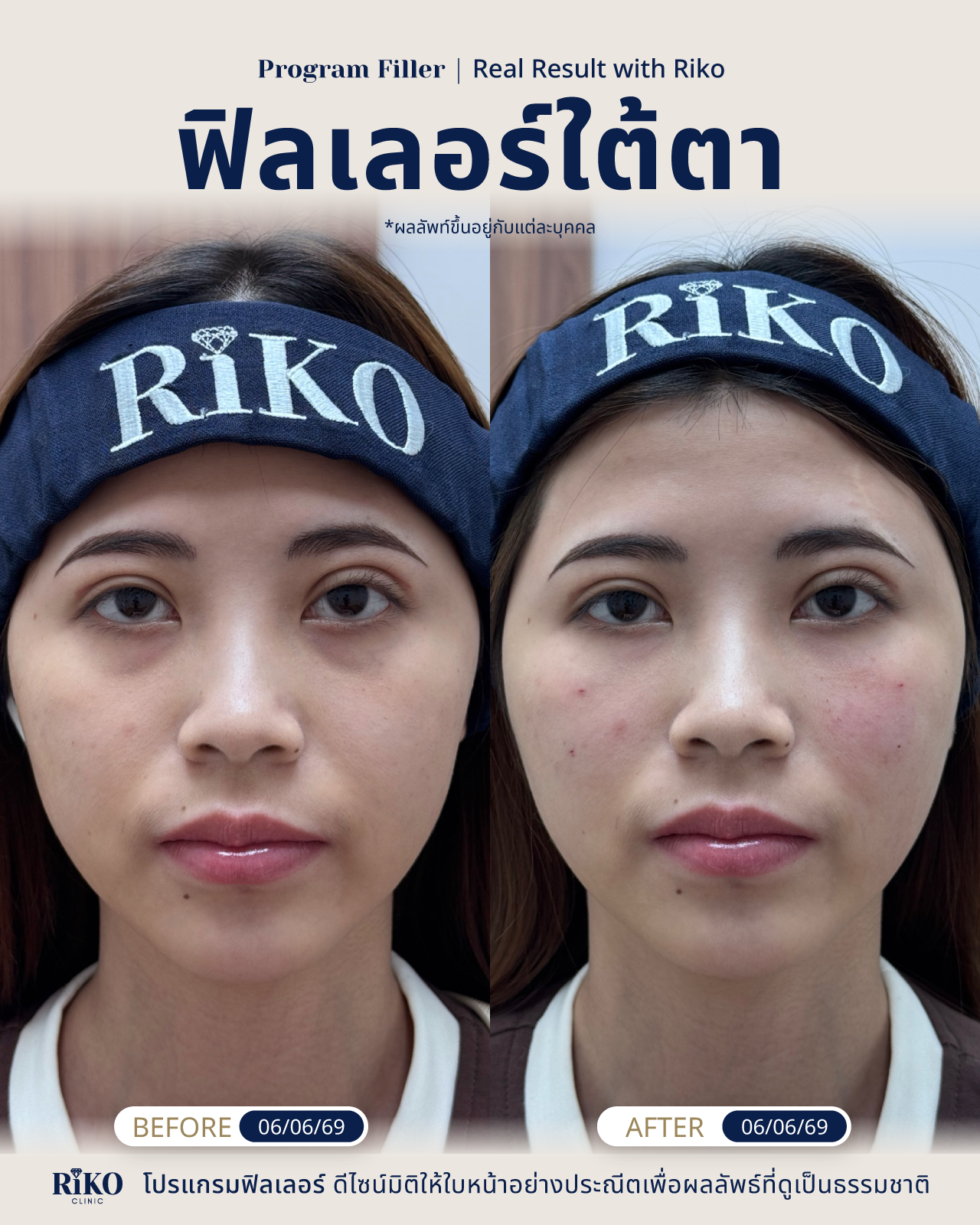 รีวิวลูกค้าฟิลเลอร์ใต้ตา | Riko Clinic ริโกะคลินิกเวชกรรม ภาพที่ 10
