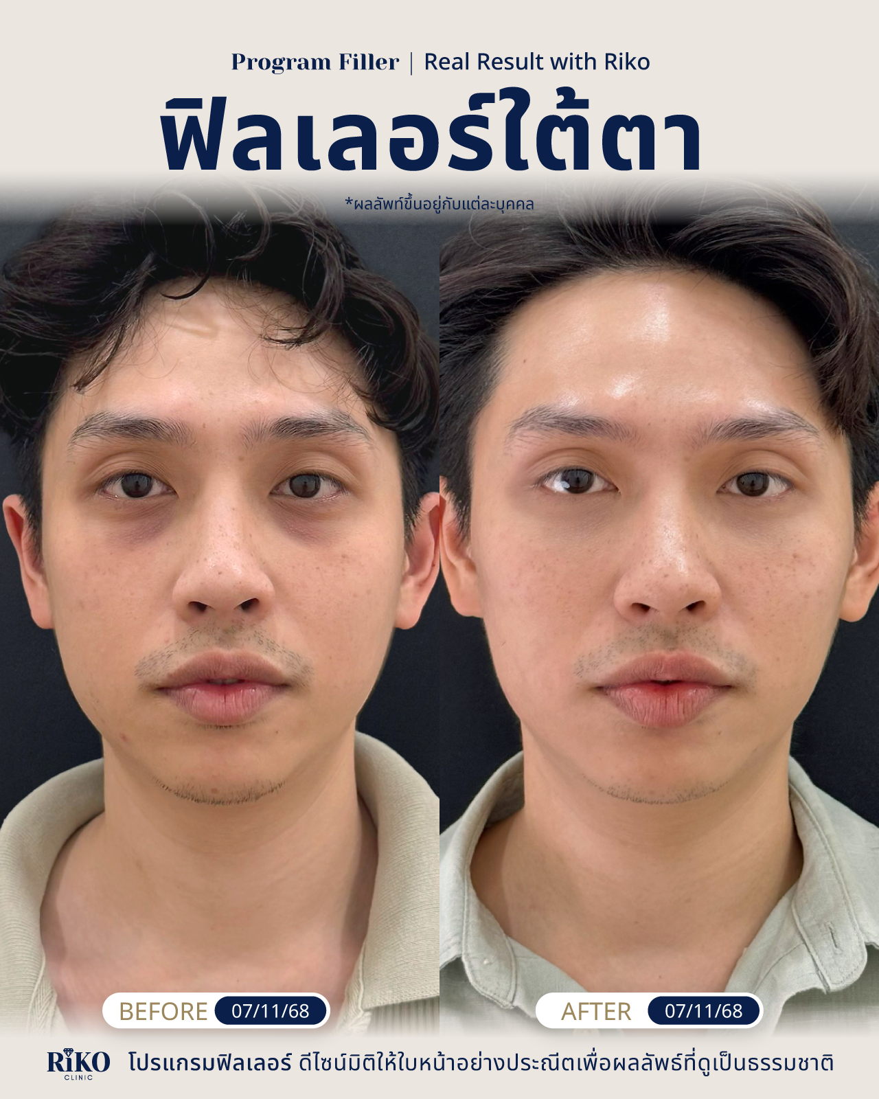 รีวิวลูกค้าฟิลเลอร์ใต้ตา | Riko Clinic ริโกะคลินิกเวชกรรม ภาพที่ 14