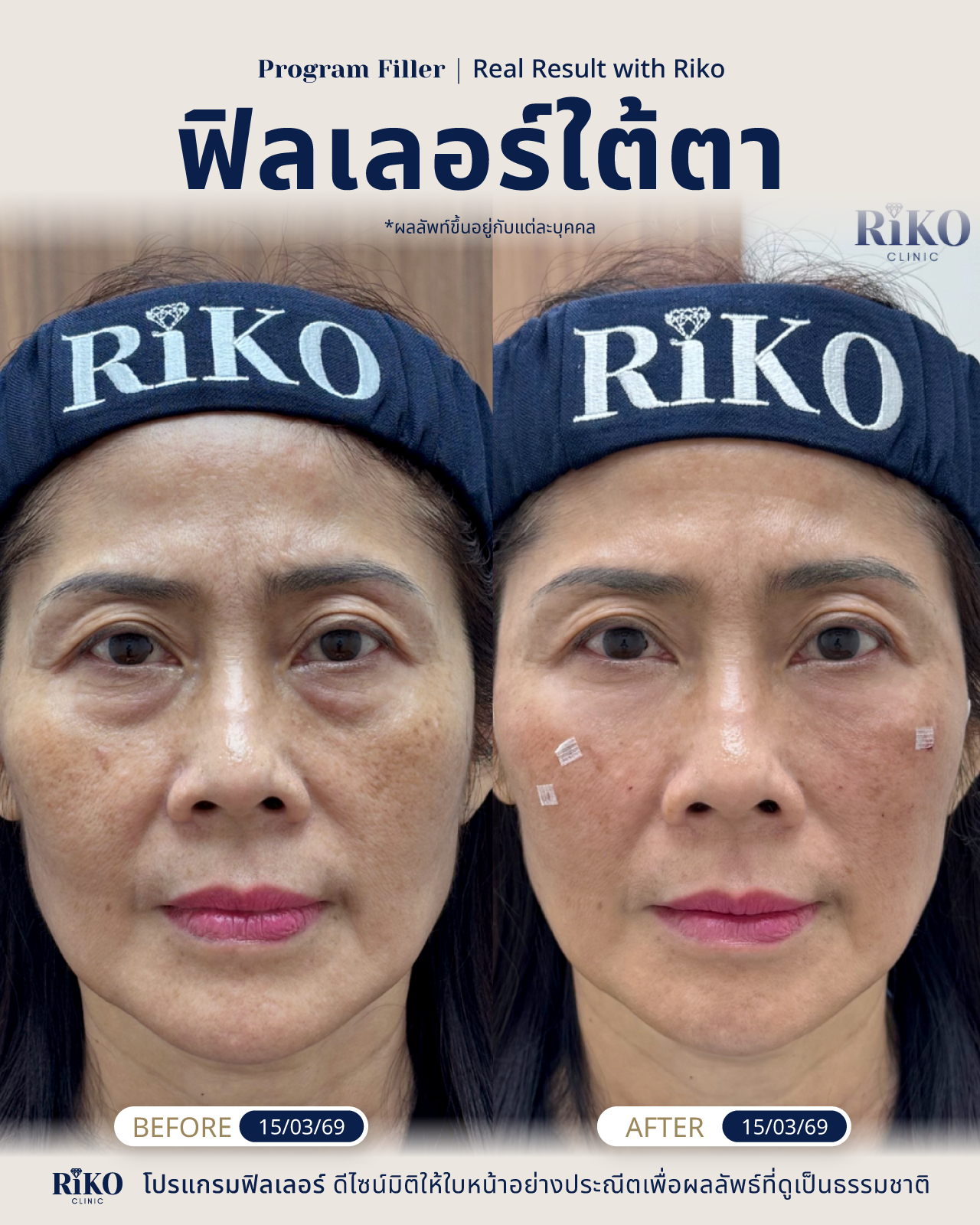 รีวิวลูกค้าฟิลเลอร์ใต้ตา | Riko Clinic ริโกะคลินิกเวชกรรม ภาพที่ 12