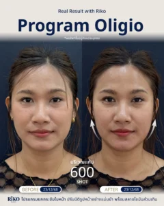 รีวิวลูกค้า Oligio | Riko Clinic ริโกะคลินิกเวชกรรม ภาพที่ 15
