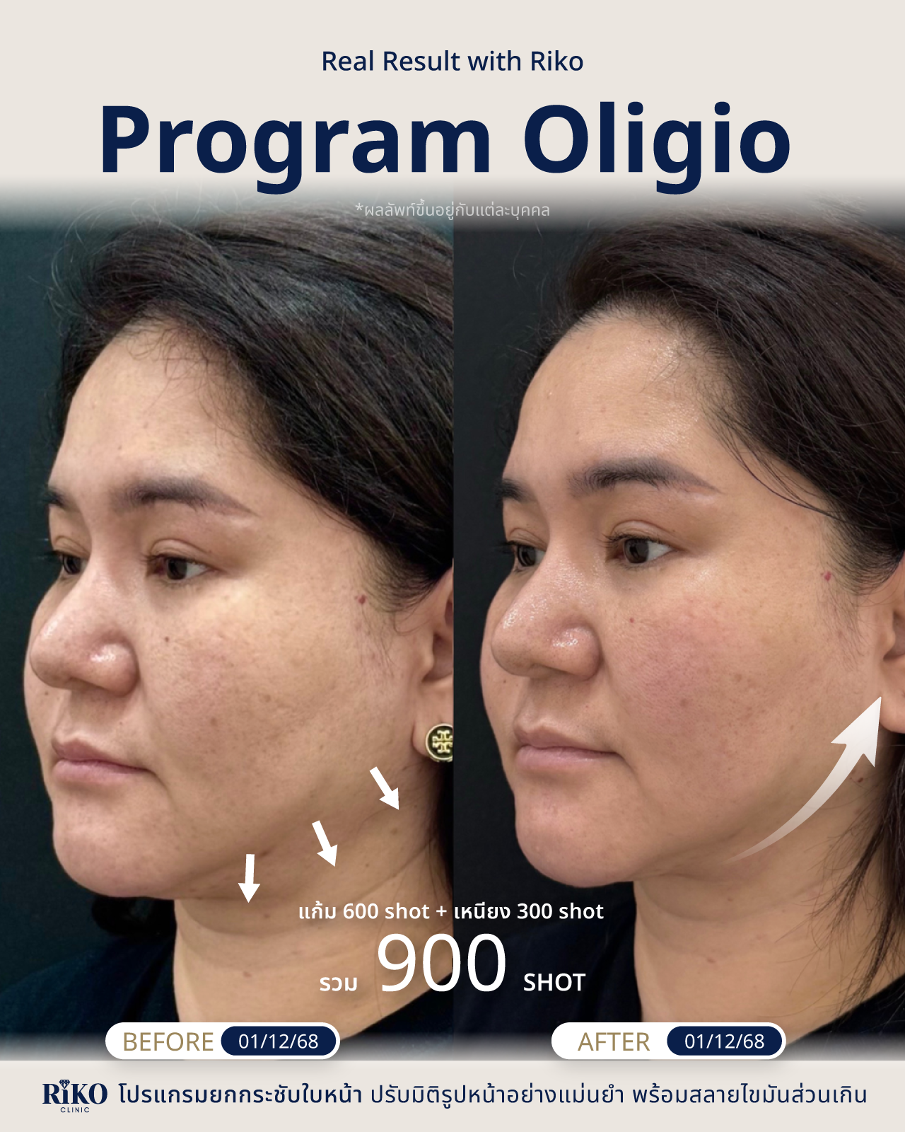 รีวิวลูกค้า Oligio | Riko Clinic ริโกะคลินิกเวชกรรม ภาพที่ 5