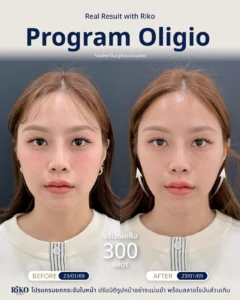 รีวิวลูกค้า Oligio | Riko Clinic ริโกะคลินิกเวชกรรม ภาพที่ 14