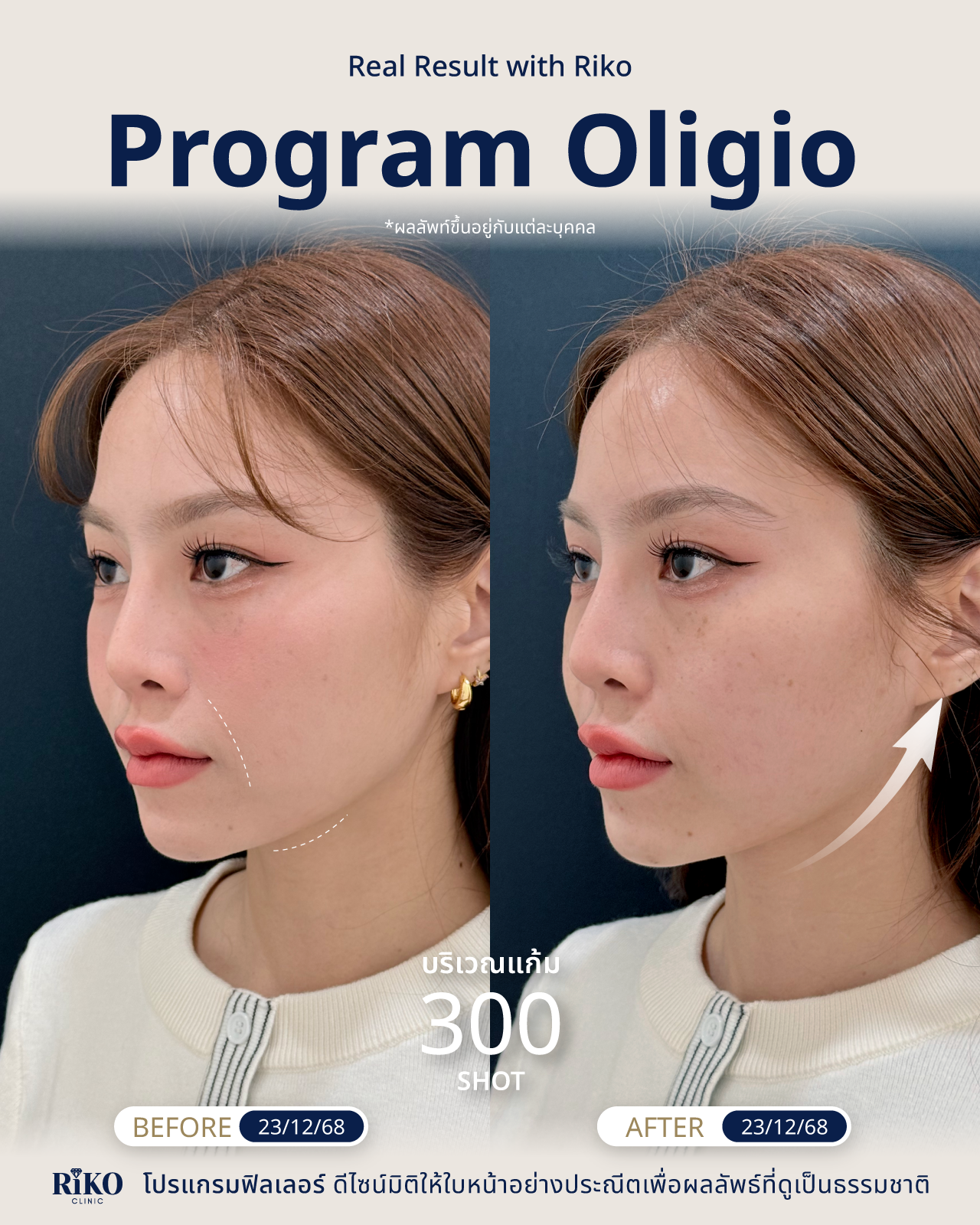 รีวิวลูกค้า Oligio | Riko Clinic ริโกะคลินิกเวชกรรม ภาพที่ 13