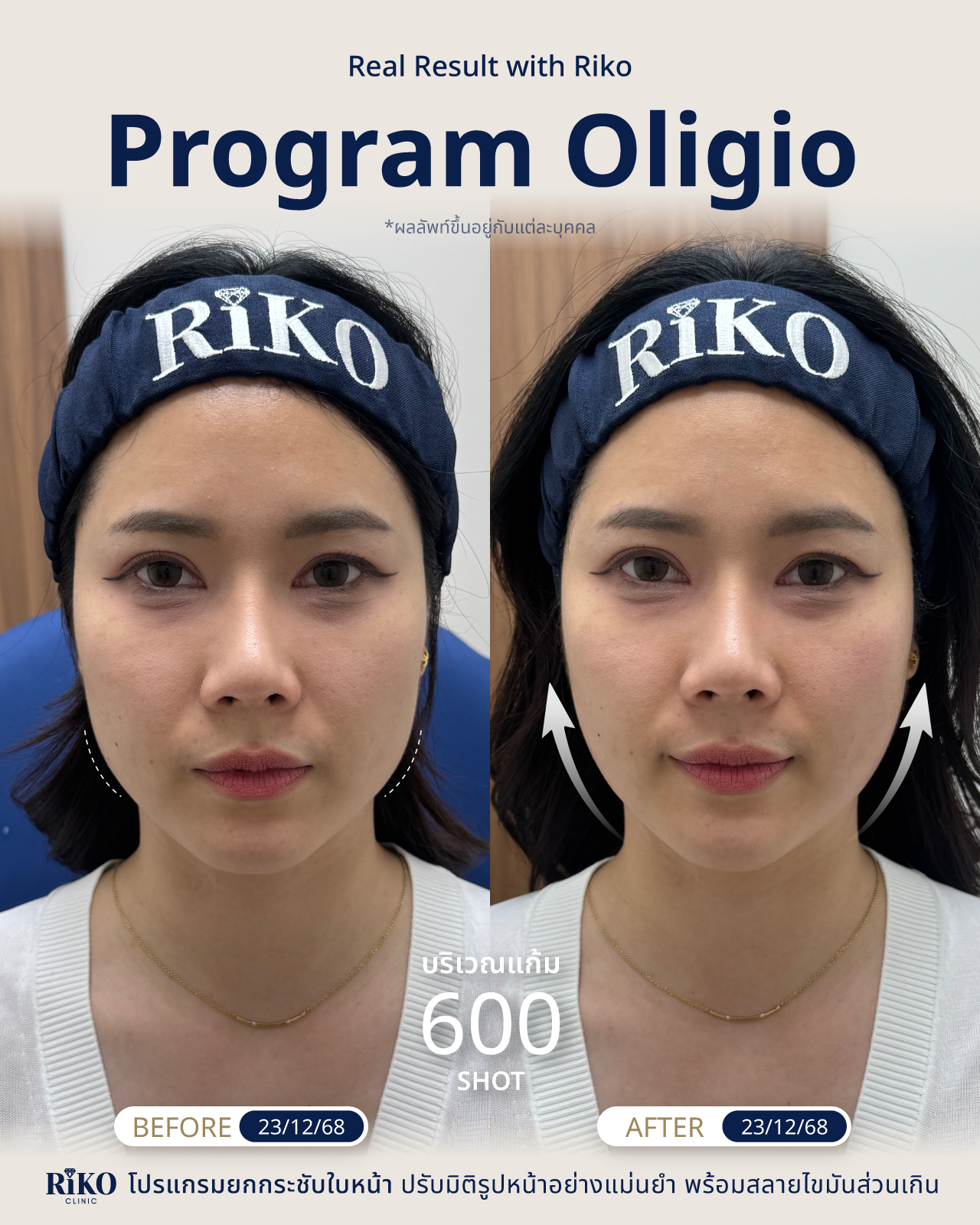 รีวิวลูกค้า Oligio | Riko Clinic ริโกะคลินิกเวชกรรม ภาพที่ 12