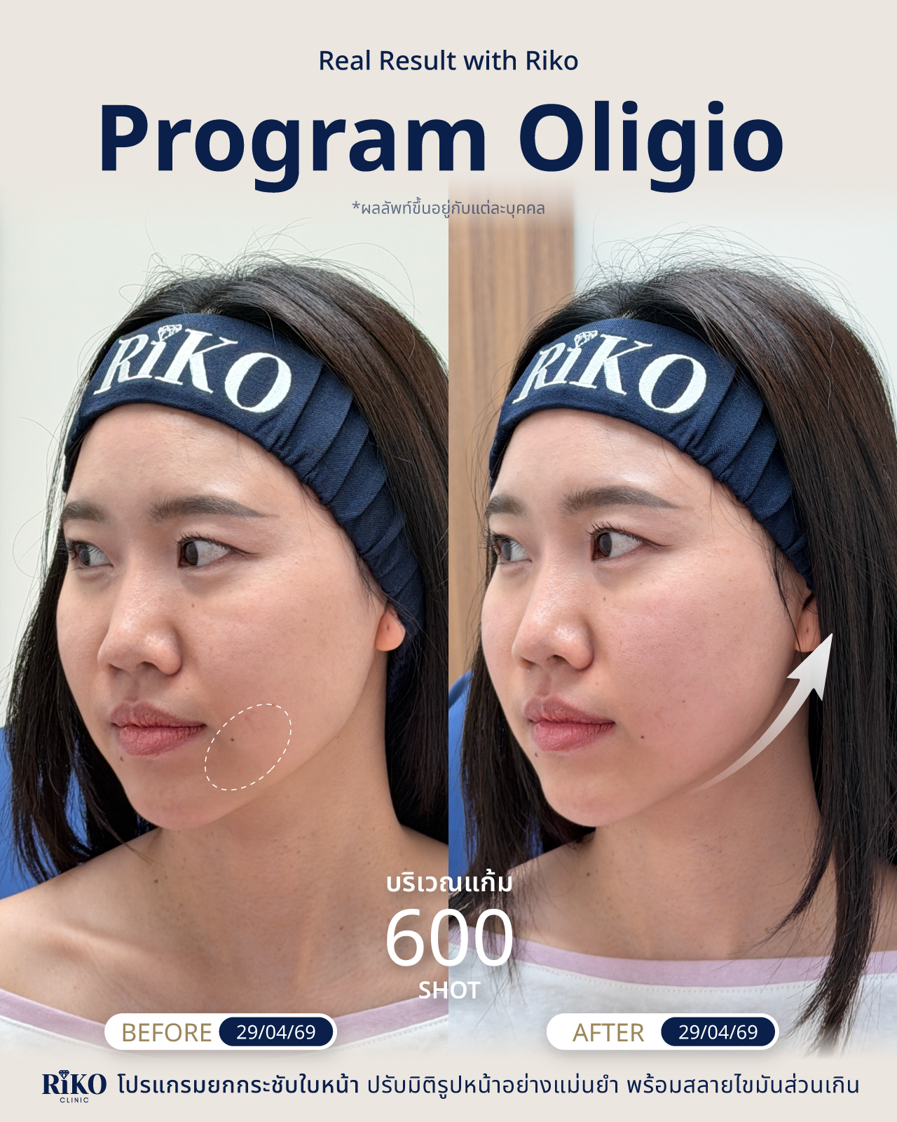 รีวิวลูกค้า Oligio | Riko Clinic ริโกะคลินิกเวชกรรม ภาพที่ 8