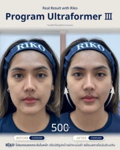 รีวิวลูกค้า Ultraformer | Riko Clinic ริโกะคลินิกเวชกรรม ภาพที่ 2