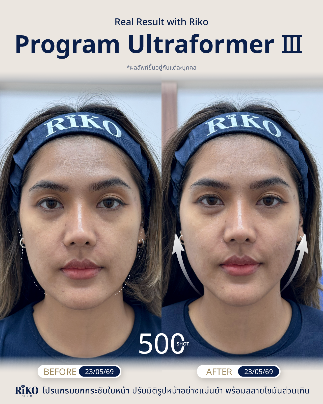 รีวิวลูกค้า Ultraformer | Riko Clinic ริโกะคลินิกเวชกรรม ภาพที่ 2