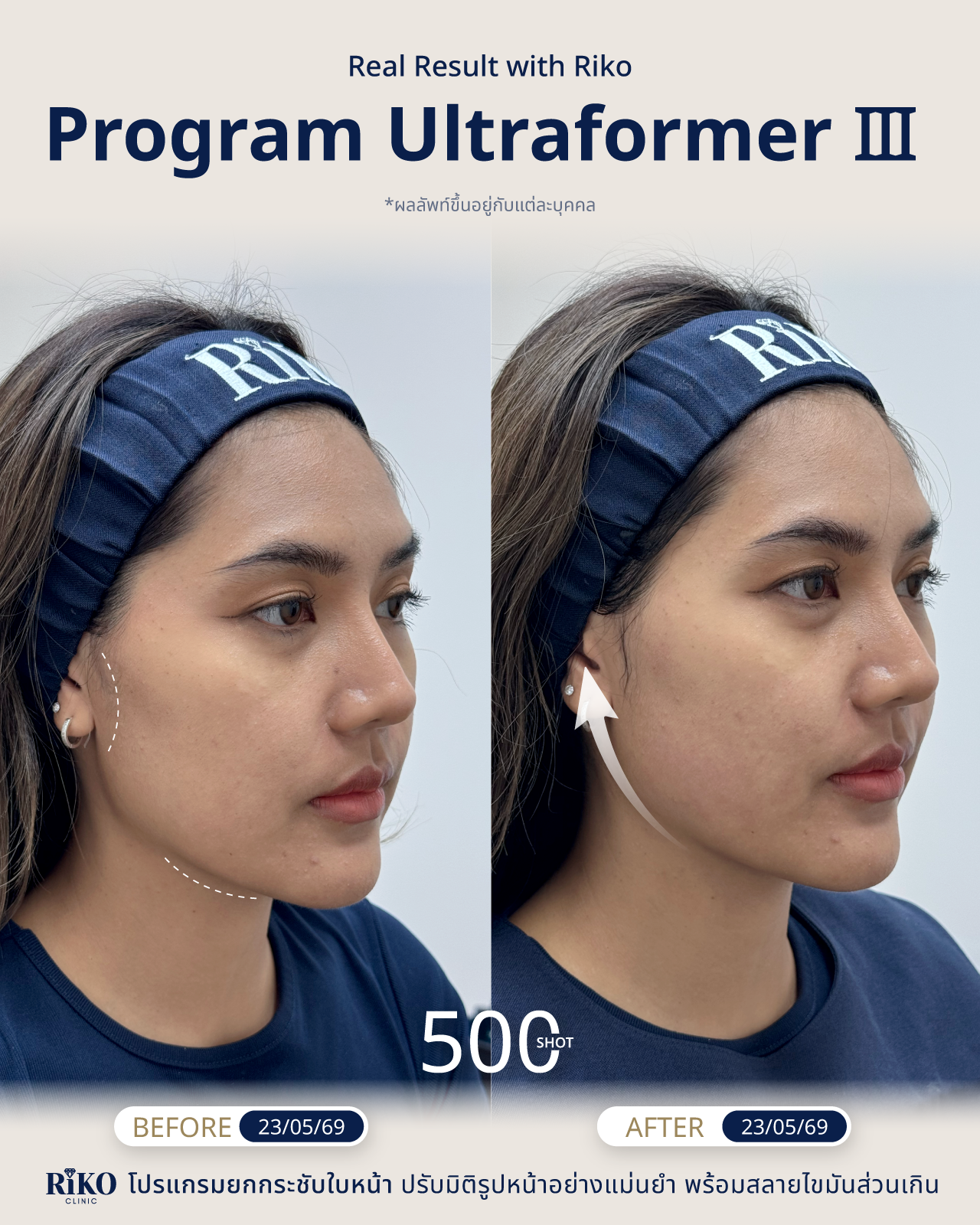 รีวิวลูกค้า Ultraformer | Riko Clinic ริโกะคลินิกเวชกรรม ภาพที่ 1