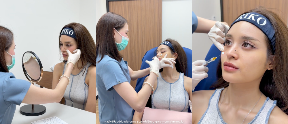 หัตถการฟิลเลอร์ Filler ปรับรูปหน้า Riko Clinic ภาพที่ 3